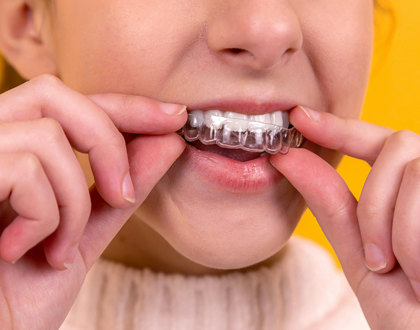 Clear aligners
