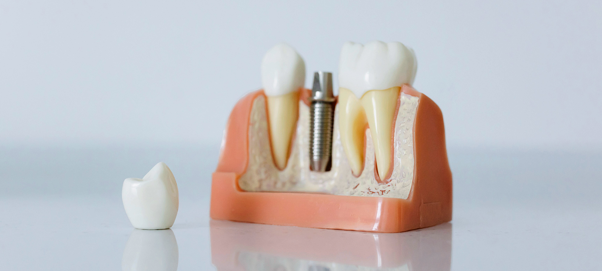 Dental implants