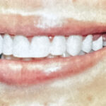 Close-up of a patient's bright white, sparkling teeth after professional teeth whitening treatment at Smile Center Silicon Valley in Sunnyvale.