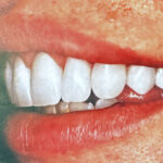 Profile view of a patient’s upper teeth after a complete smile transformation in Sunnyvale, showcasing ideal tooth length and lip support.
