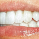 Side close-up of a patient's perfectly aligned upper and lower bite following a comprehensive smile design in Sunnyvale.
