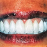 Close-up of a perfectly symmetrical, bright white smile makeover showcasing premium cosmetic dentistry at Smile Center Silicon Valley in Sunnyvale.