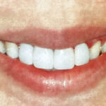 Close-up of a patient smiling broadly showcasing a full set of bright white porcelain veneers at Smile Center Silicon Valley in Sunnyvale.
