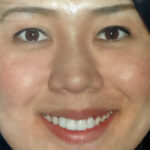 Portrait of a smiling woman displaying a bright, beautifully aligned smile after a cosmetic dentistry transformation at Smile Center Silicon Valley in Sunnyvale.