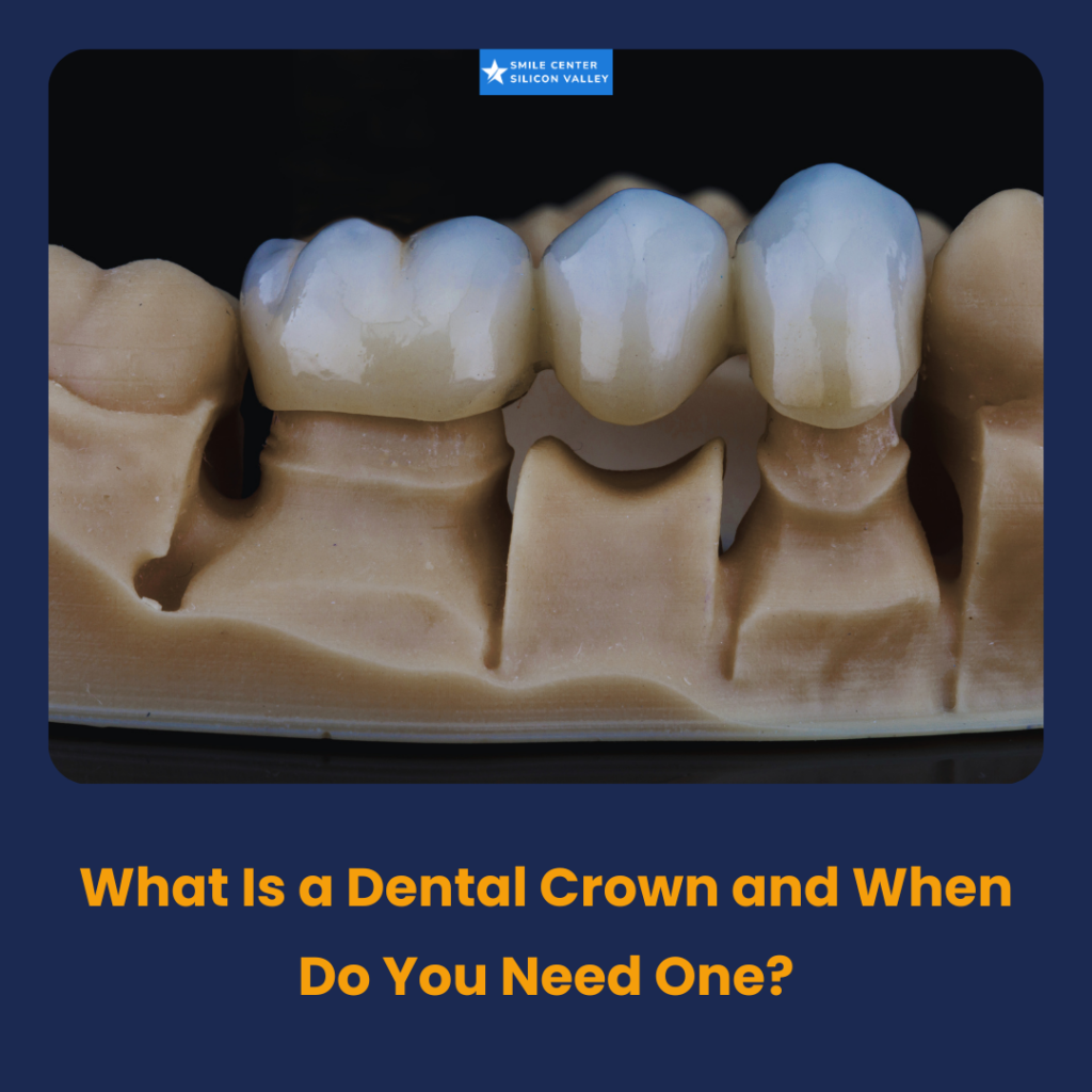 A close-up of a dentist holding a natural-looking porcelain dental crown next to a modern dental model.